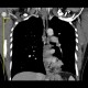 Oesophagitis, corrosive oesophagitis, lye ingestion, CPR: CT - Computed tomography